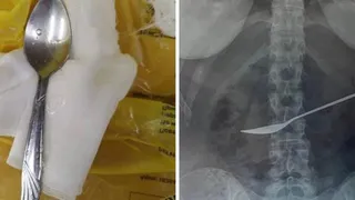 Вологодские врачи извлекли из желудка пациентки металлическую ложку