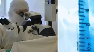 Вологодские микрохирурги вернули зрение рабочему после тяжелого ранения глаза